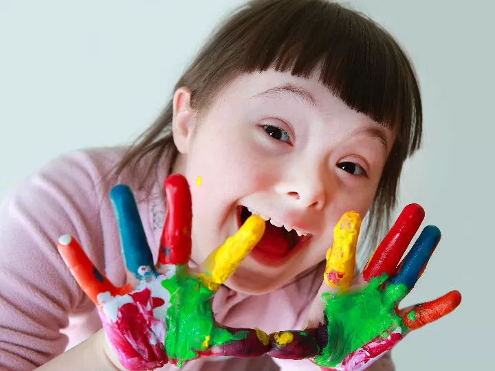 sindrome-down-padecimiento