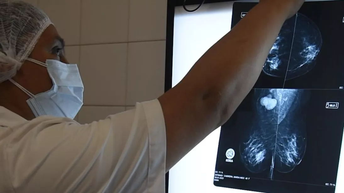 CANCER MAMA MAMOGRAFIA